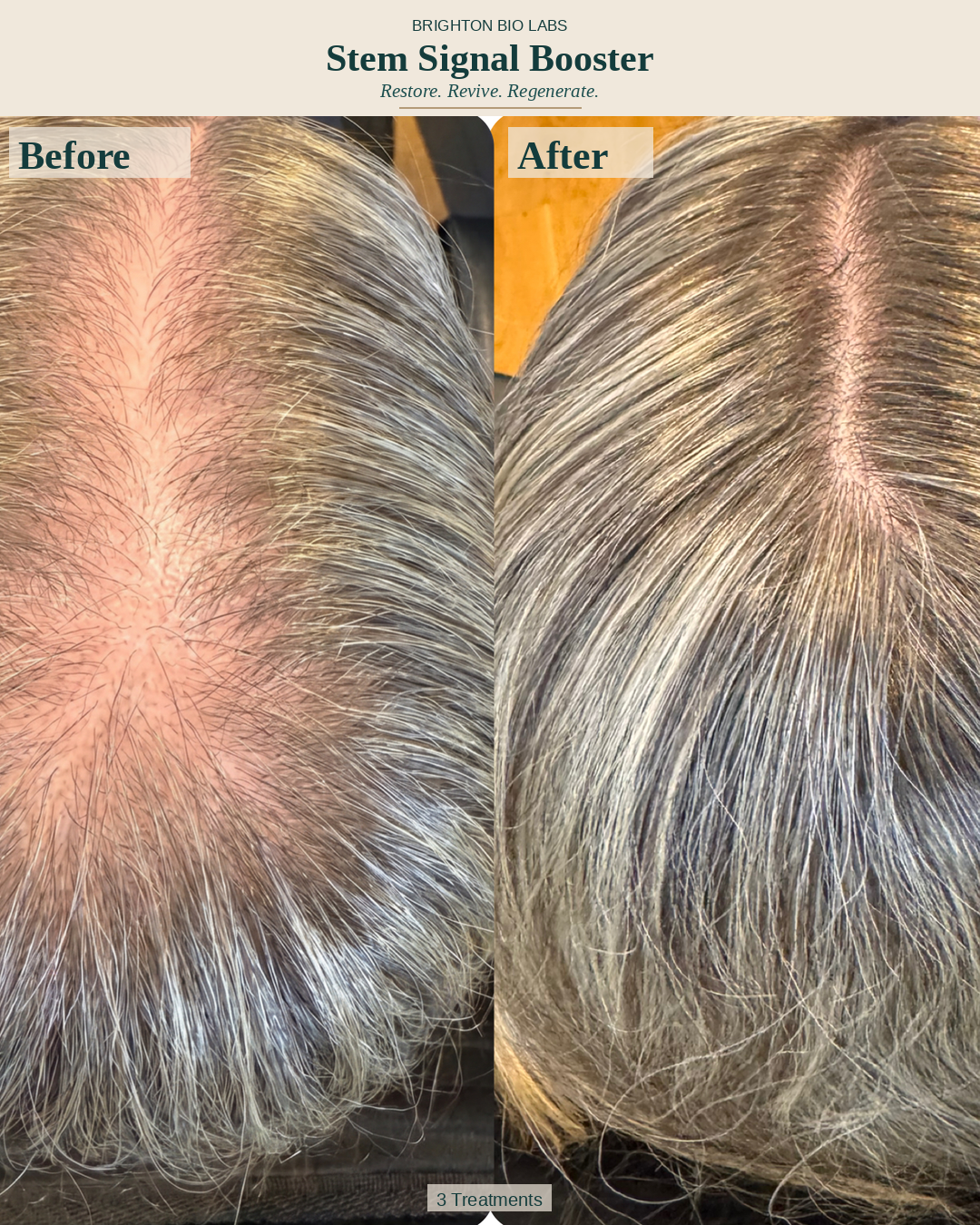 Before - Female Pattern Hair Loss